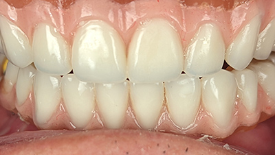 Implant surgery case 4 after 2