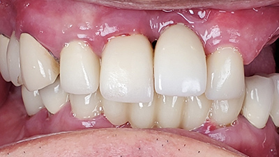 Implant surgery case 4 before 2