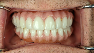 Implant surgery case 5 after 2