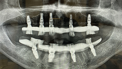Implant surgery case 5 after 3