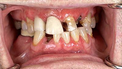 Implant surgery case 5 before 2