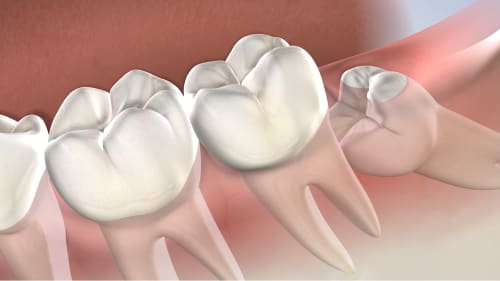 Wisdom Teeth Removal Post Operative Instructions At Amarillo Oral Maxillofacial Surgery