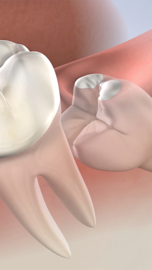 Wisdom Teeth Removal In Amarillo Tx