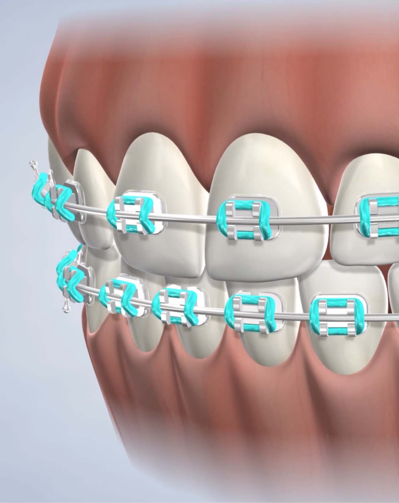 Braces in omaha, ne