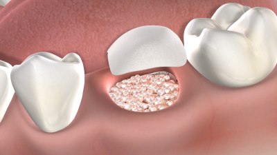 Post Operative Instructions Bone Grafting At Lehman Menis Dental Implant And Oral Surgery Specialists
