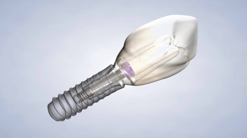 Post-Operative Instructions: Dental Implants