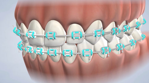 How to change the colorful rubber bands for orthodontics. Make sure to, Rubber Band Braces