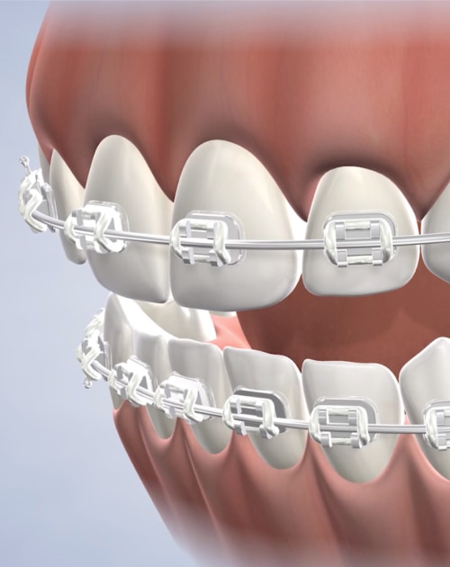 What Can Rubber Bands Do for My Bite? - iSmile Orthodontics