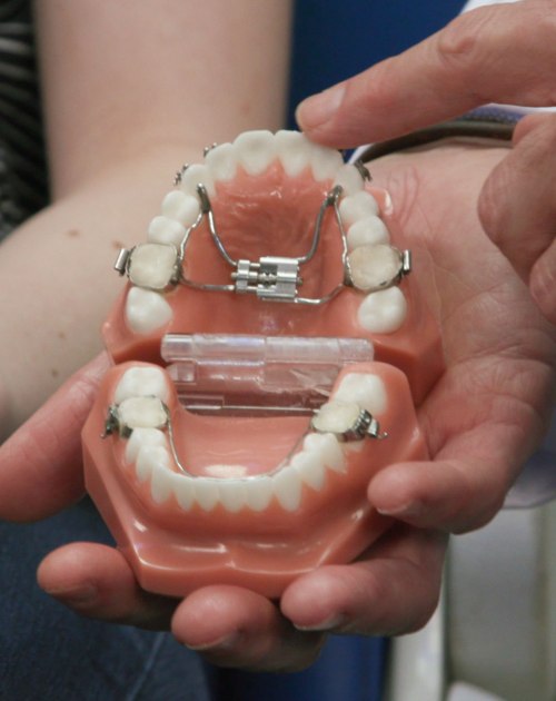 Orthodontist Treatment Options for an Overbite