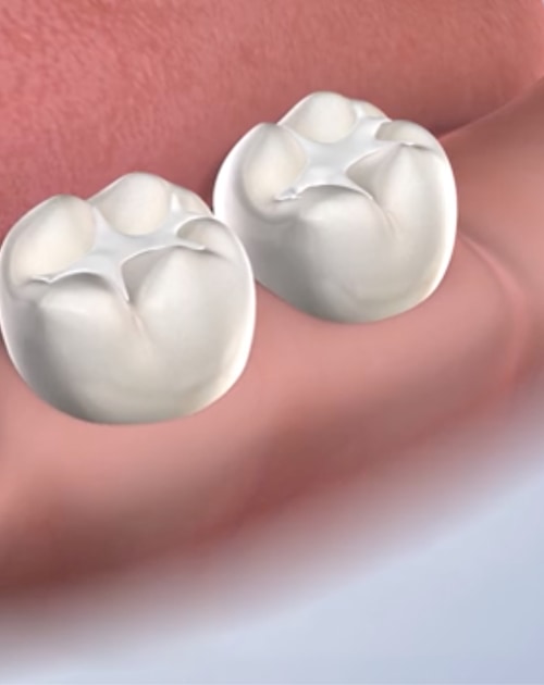 Gold And Amalgam Fillings - Westerville Dental Associates