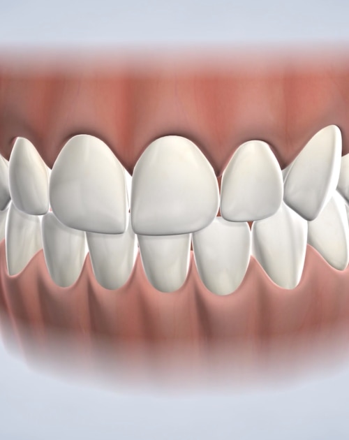 Icon® Dental Treatment  White Spots and Discolored Tooth