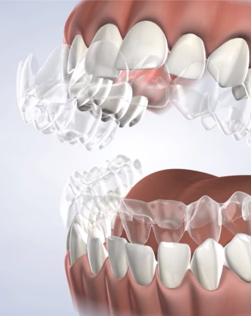 Invisalign