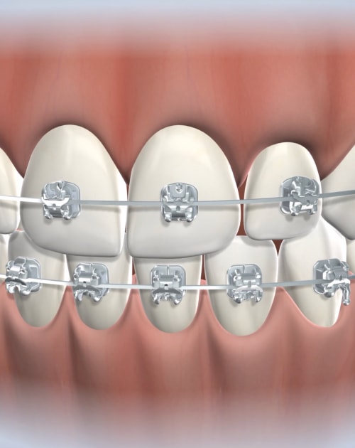 Triangle braces for teeth discount