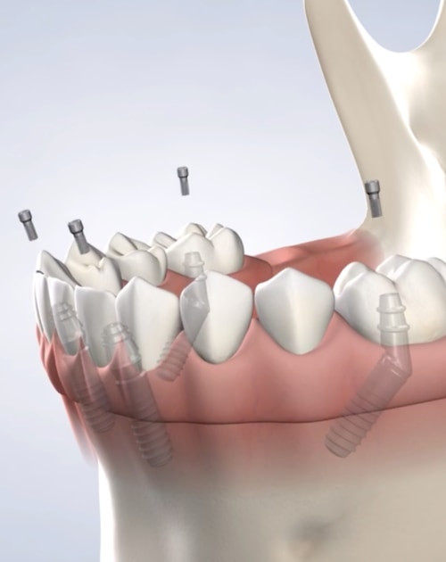 Tooth removal with laser: Advantages and procedure - missionimplantcenter