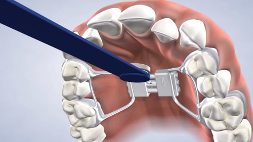 Instrucciones para protectores bucales en Nalchajian Orthodontics en  Fresno, CA, y Clovis, CA