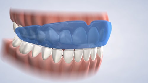 Instrucciones para protectores bucales en Nalchajian Orthodontics en  Fresno, CA, y Clovis, CA