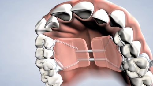 What is a Palatal Expander?