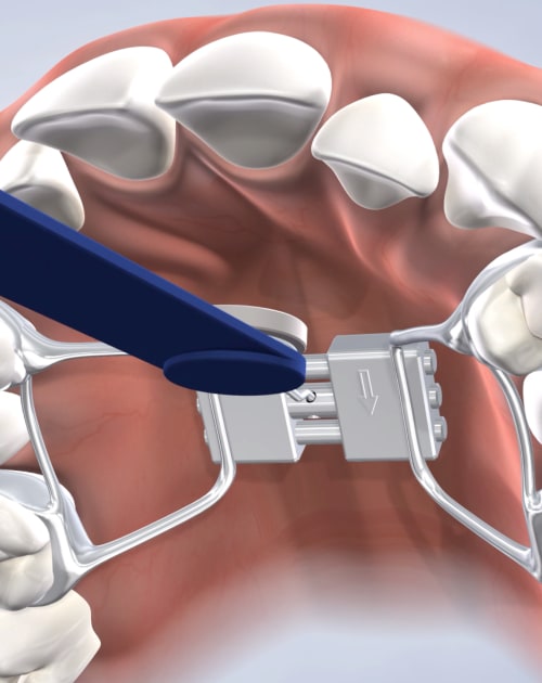 Palatal Expander in Fresno, CA, & Clovis, CA, at Nalchajian