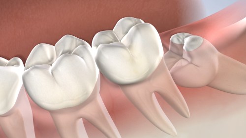 Post Operative Instructions Wisdom Teeth Removal In Naperville Il