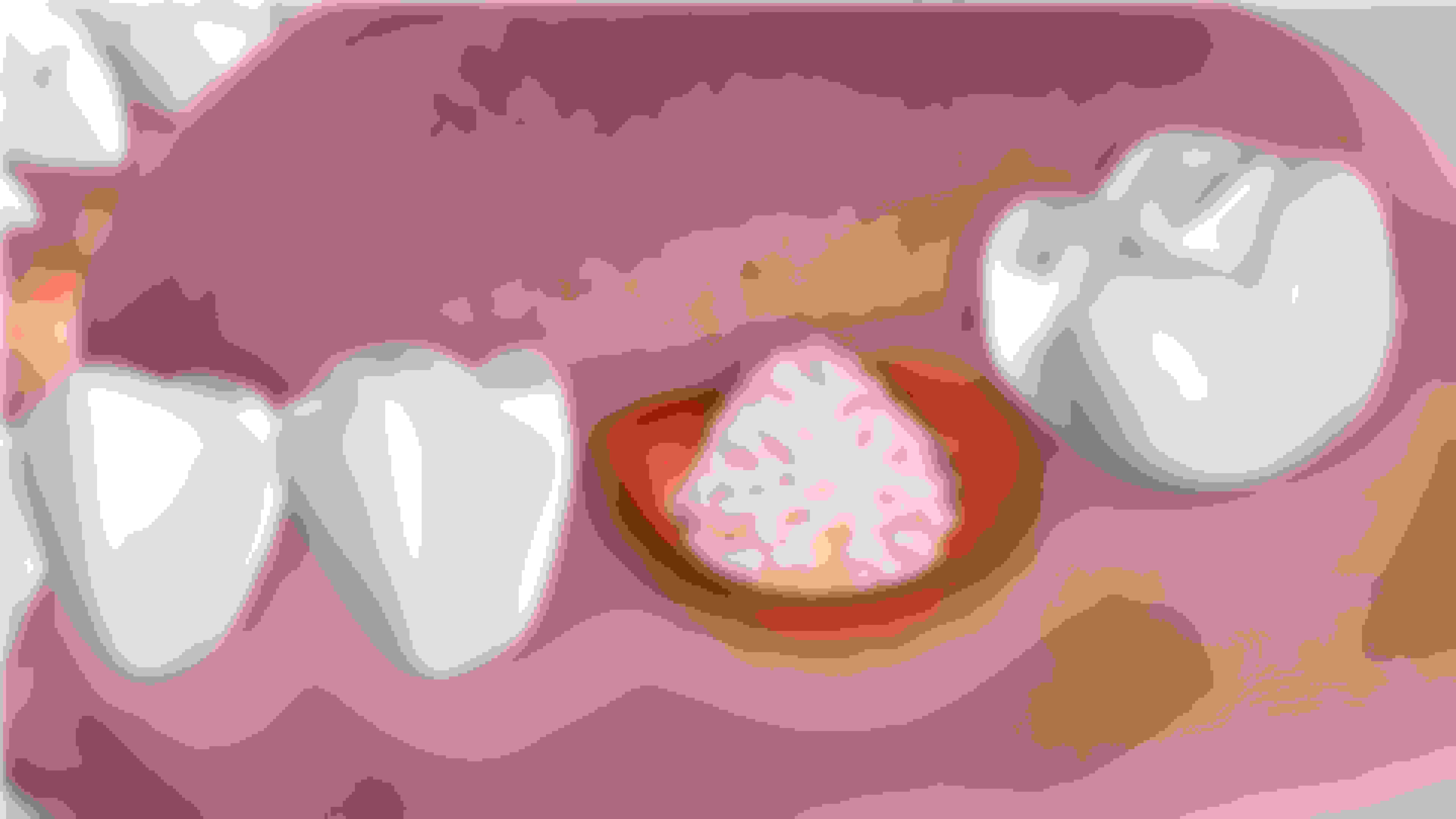 Bone graft post-operative instructions