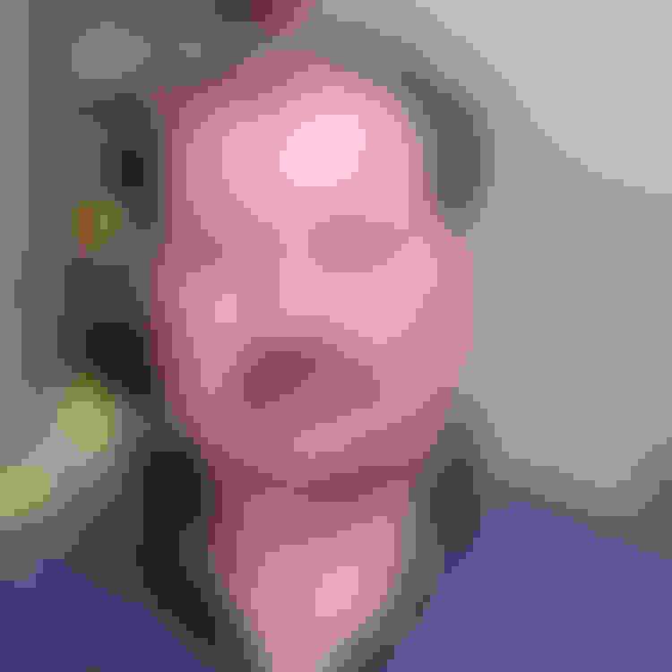 Frank had oral surgery at Oral Surgery Group