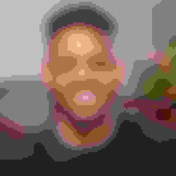 Malcom had oral surgery at Oral Surgery Group