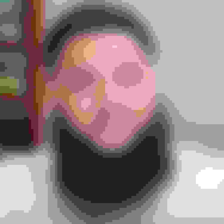 Richie had oral surgery at Oral Surgery Group