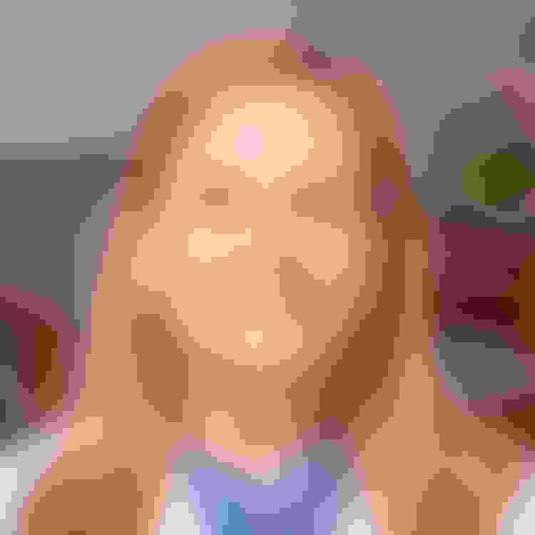 Susan had a bone graft and a dental implant placed in East Brunswick, NJ