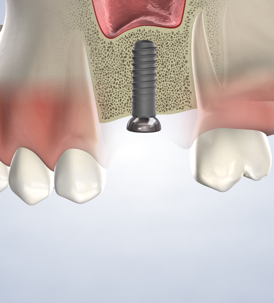 Bone Grafting in Gresham, The Dalles, and Milwaukie, OR, and Camas, WA