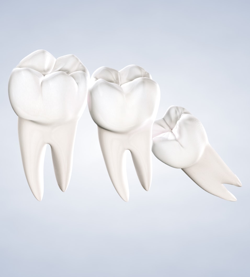 Wisdom Teeth Extractions in Gresham, The Dalles, and Milwaukie, OR, and Camas, WA