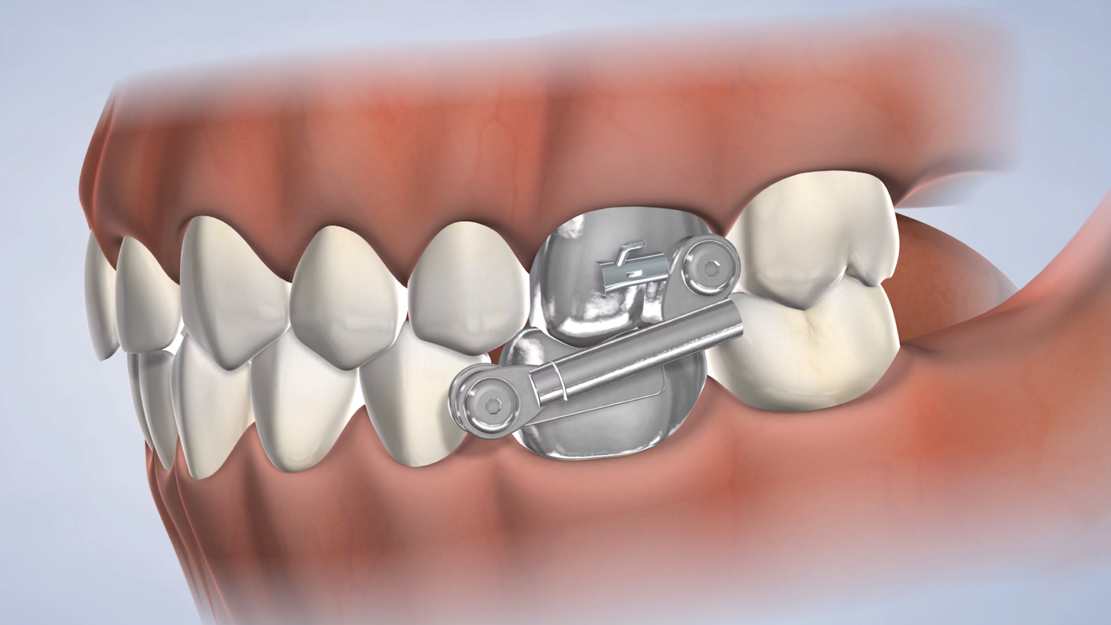 Instructions to manage a herbst appliance for teeth.