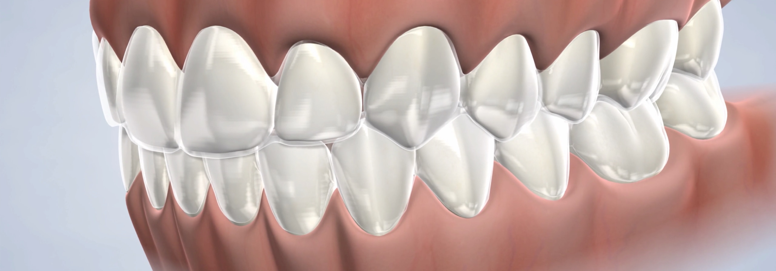 Invisalign in Omaha, NE