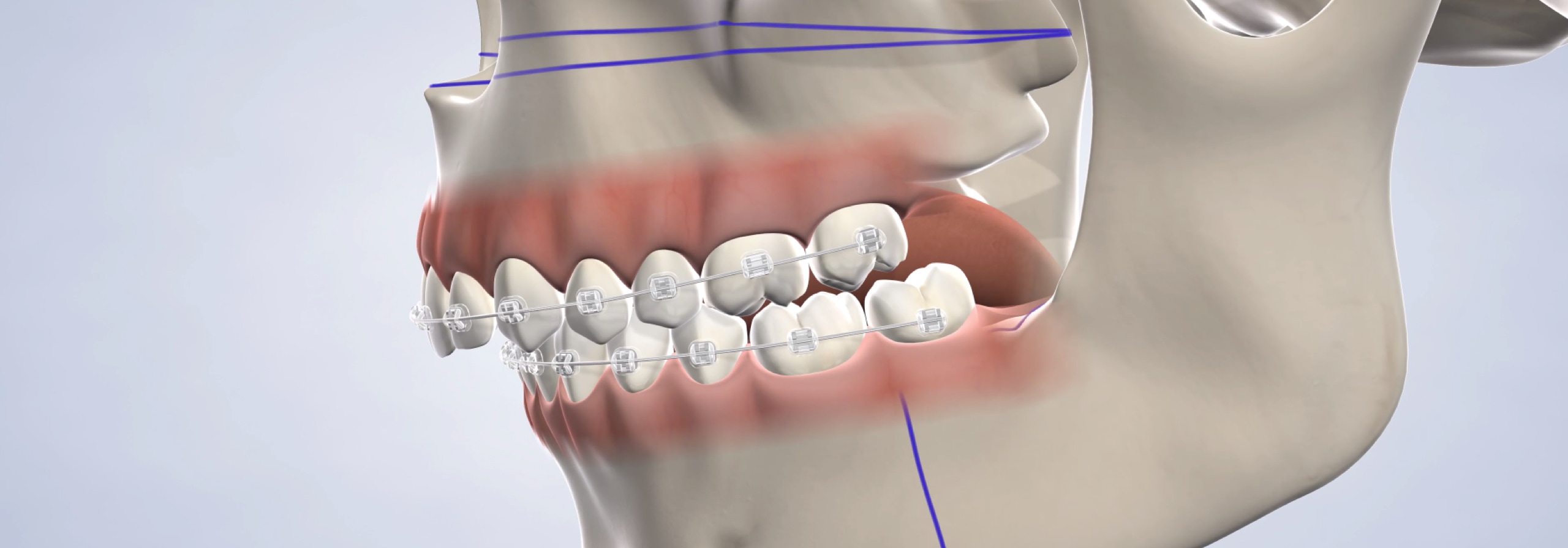 Corrective jaw surgery in Dumas, Canyon, Amarillo, Farwell, and Dalhart, TX