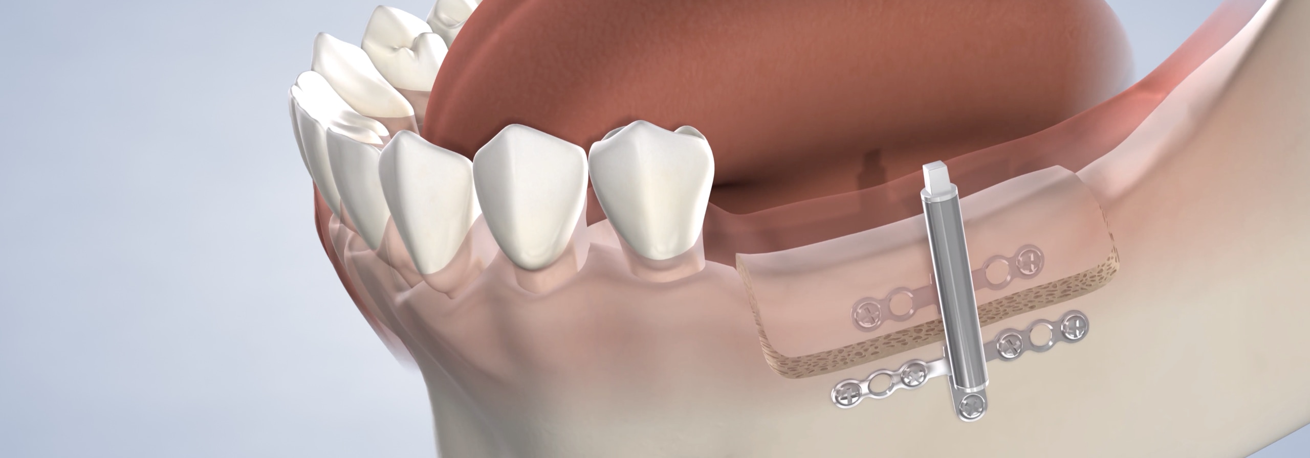 Osteogenesis in Dumas, Canyon, Amarillo, Farwell, and Dalhart, TX