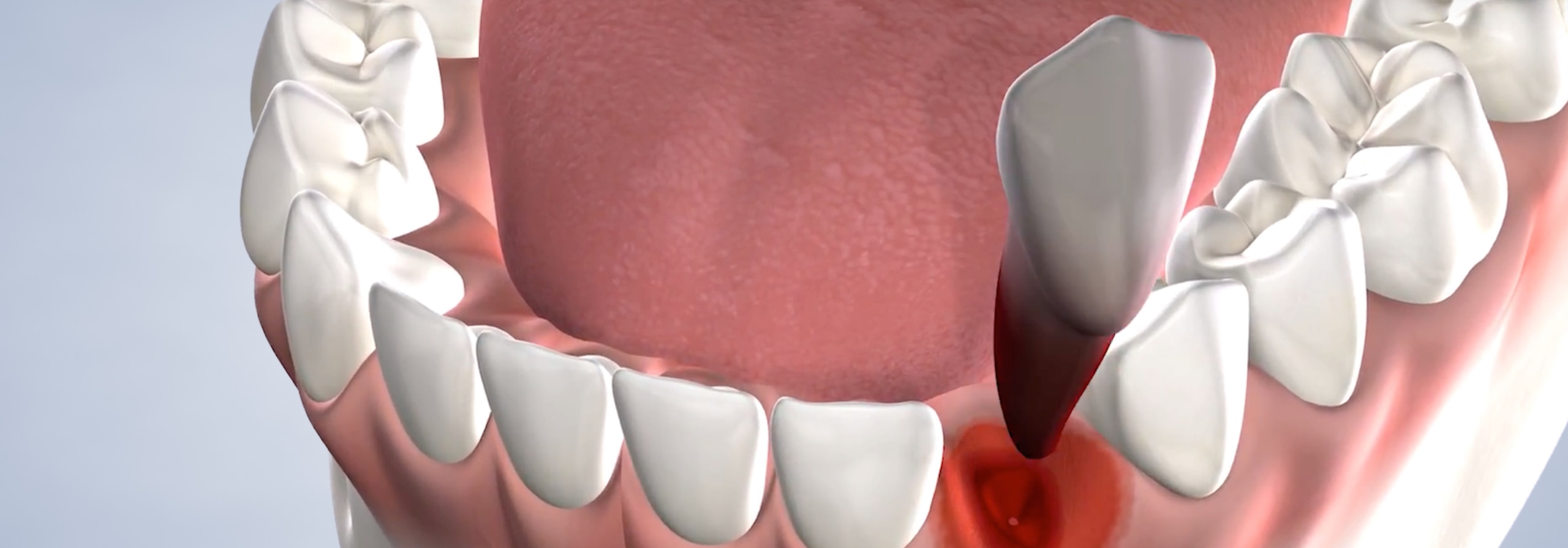 Tooth extractions in Dumas, Canyon, Amarillo, Farwell, and Dalhart, TX