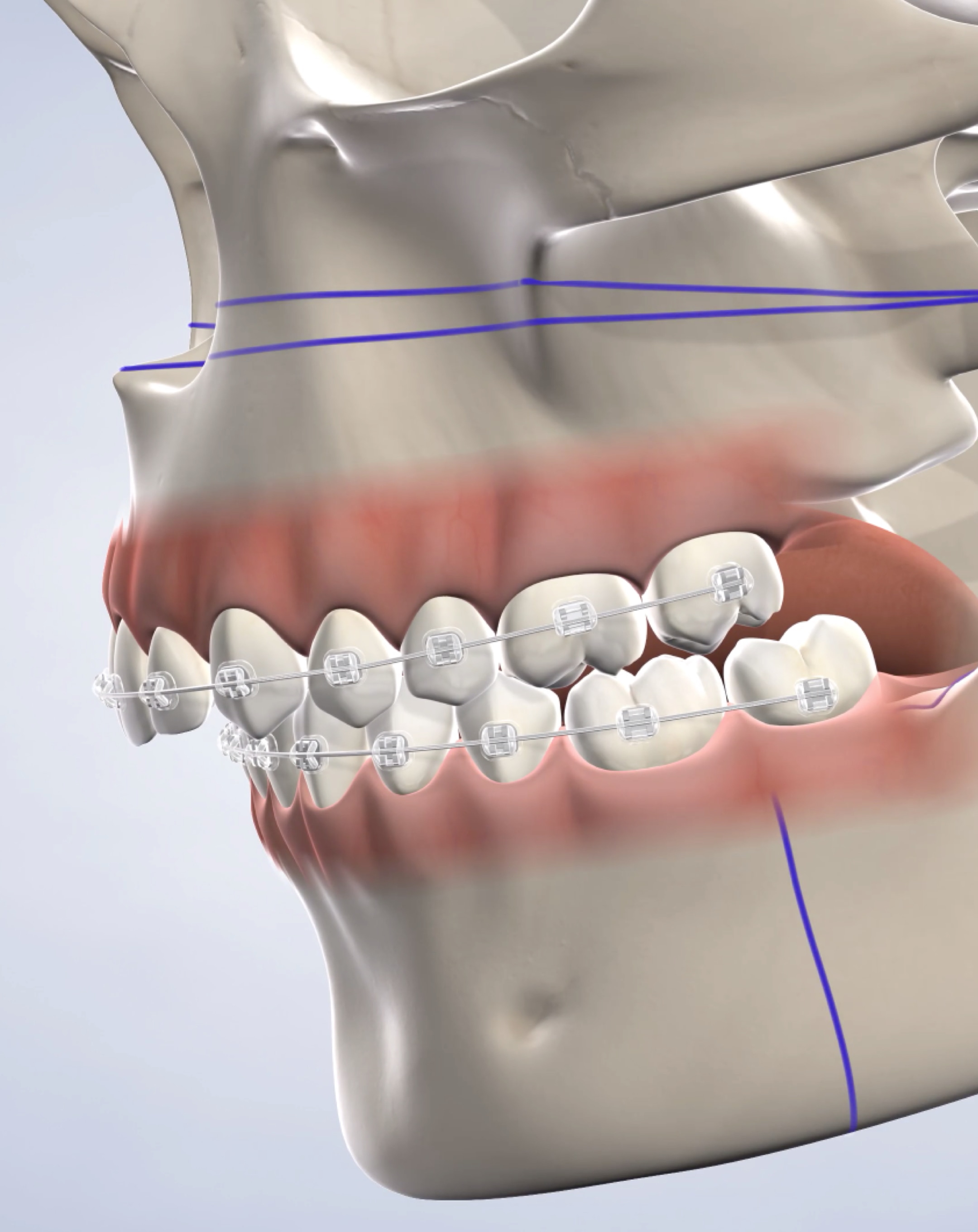 Jaw surgery in Dumas, Canyon, Amarillo, Farwell, and Dalhart, TX