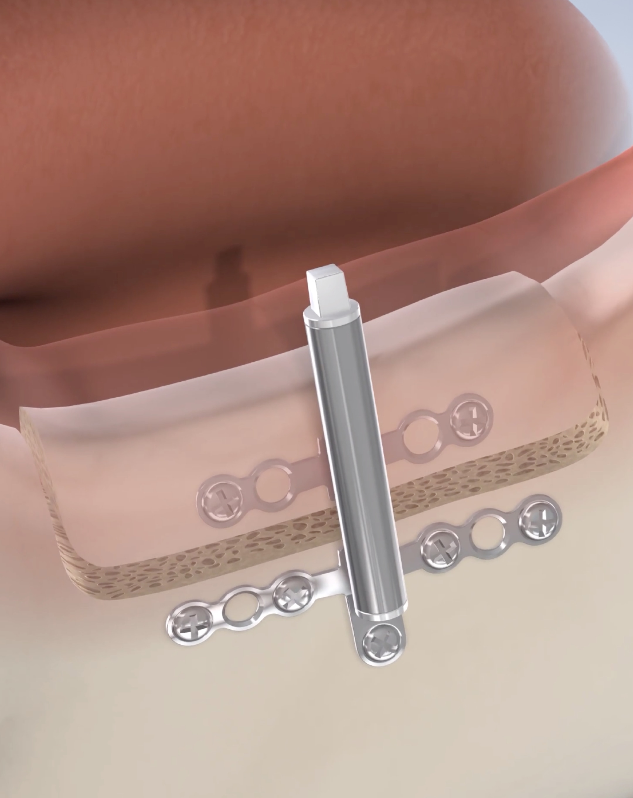 Osteogenesis in Dumas, Canyon, Amarillo, Farwell, and Dalhart, TX