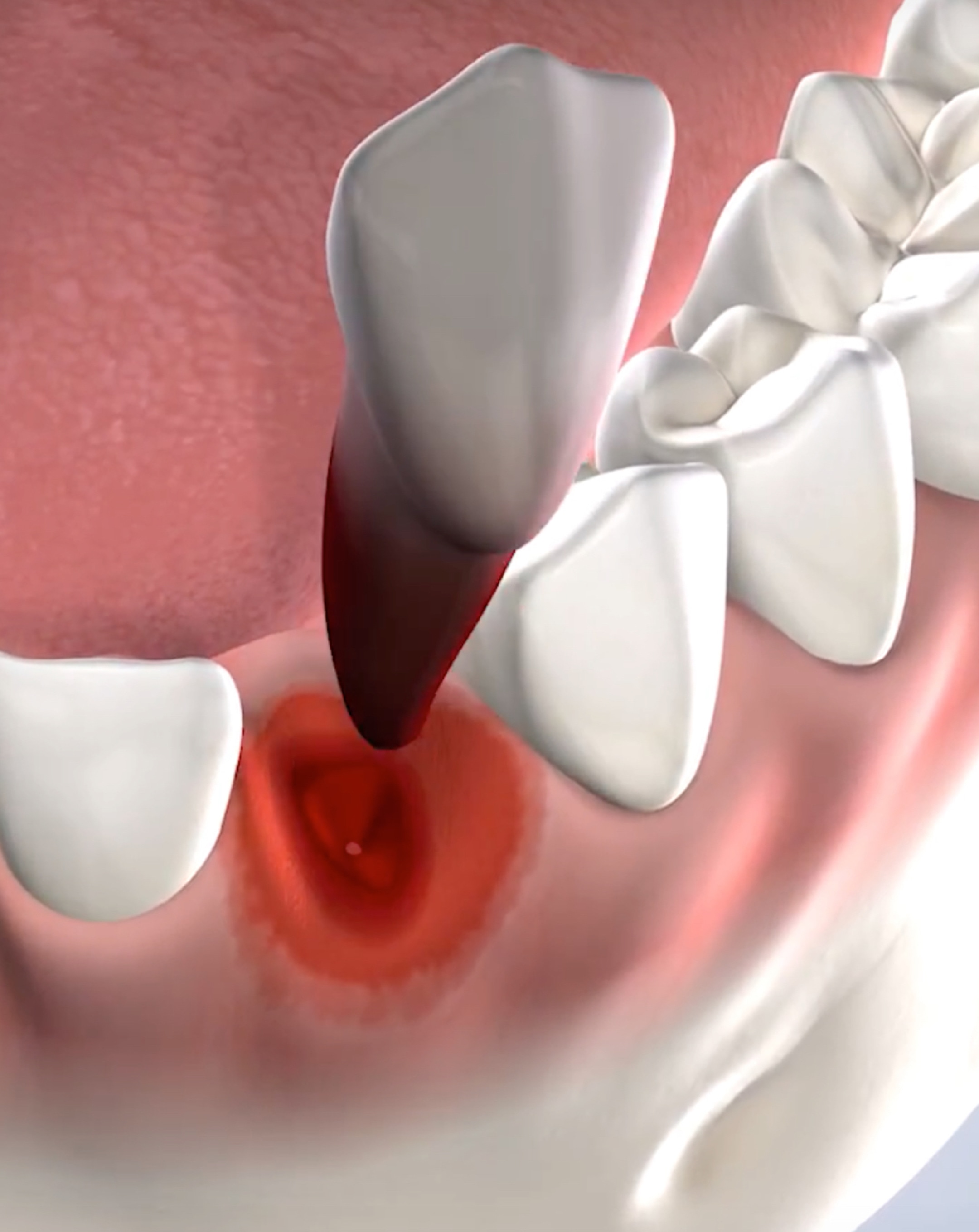 Tooth extractions in Dumas, Canyon, Amarillo, Farwell, and Dalhart, TX