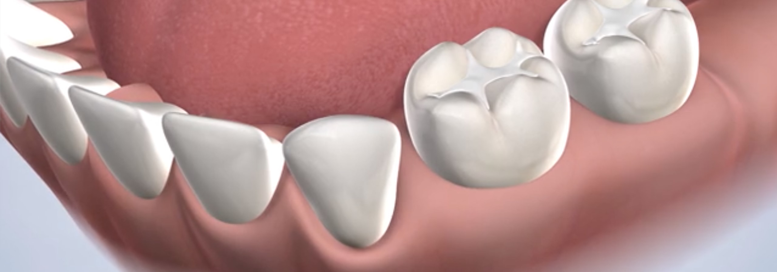 Dental fillings in Dumas, Canyon, Amarillo, Farwell, and Dalhart, TX