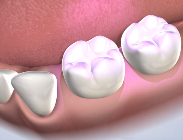 Dental sealants in Dumas, Canyon, Amarillo, Farwell, and Dalhart, TX
