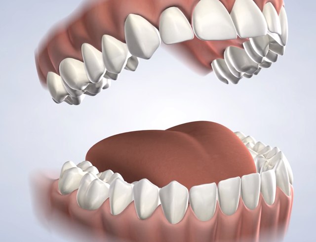 Fluoride varnish in Dumas, Canyon, Amarillo, Farwell, and Dalhart, TX