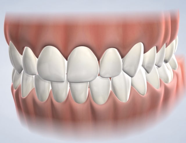 Icon discolored tooth treatment in Dumas, Canyon, Amarillo, Farwell, and Dalhart, TX