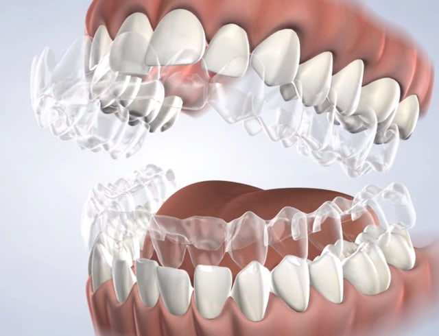Invisalign® in Dumas, Canyon, Amarillo, Farwell, and Dalhart, TX