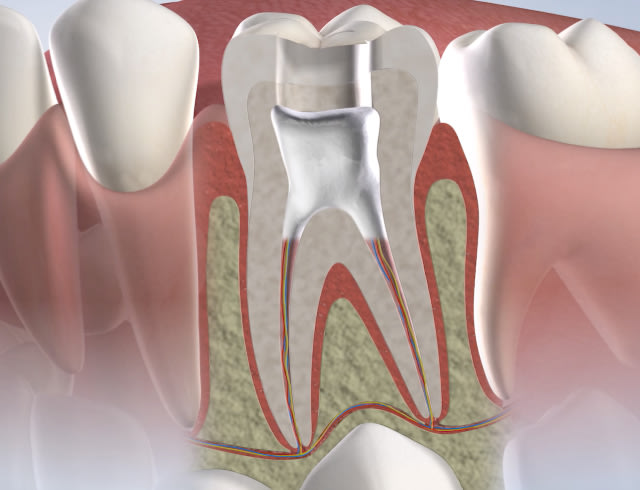 Root Canals in Dumas, Canyon, Amarillo, Farwell, and Dalhart, TX