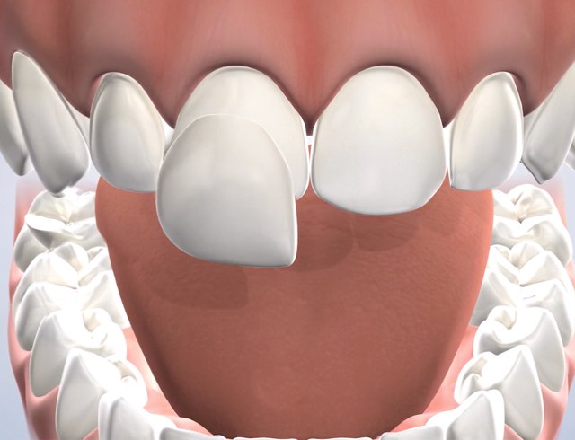 Veneers in Dumas, Canyon, Amarillo, Farwell, and Dalhart, TX