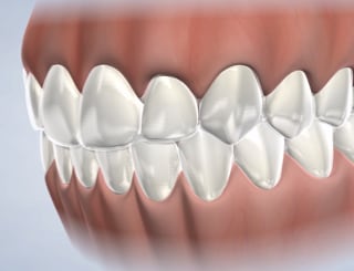 Teeth whitening in Dumas, Canyon, Amarillo, Farwell, and Dalhart, TX