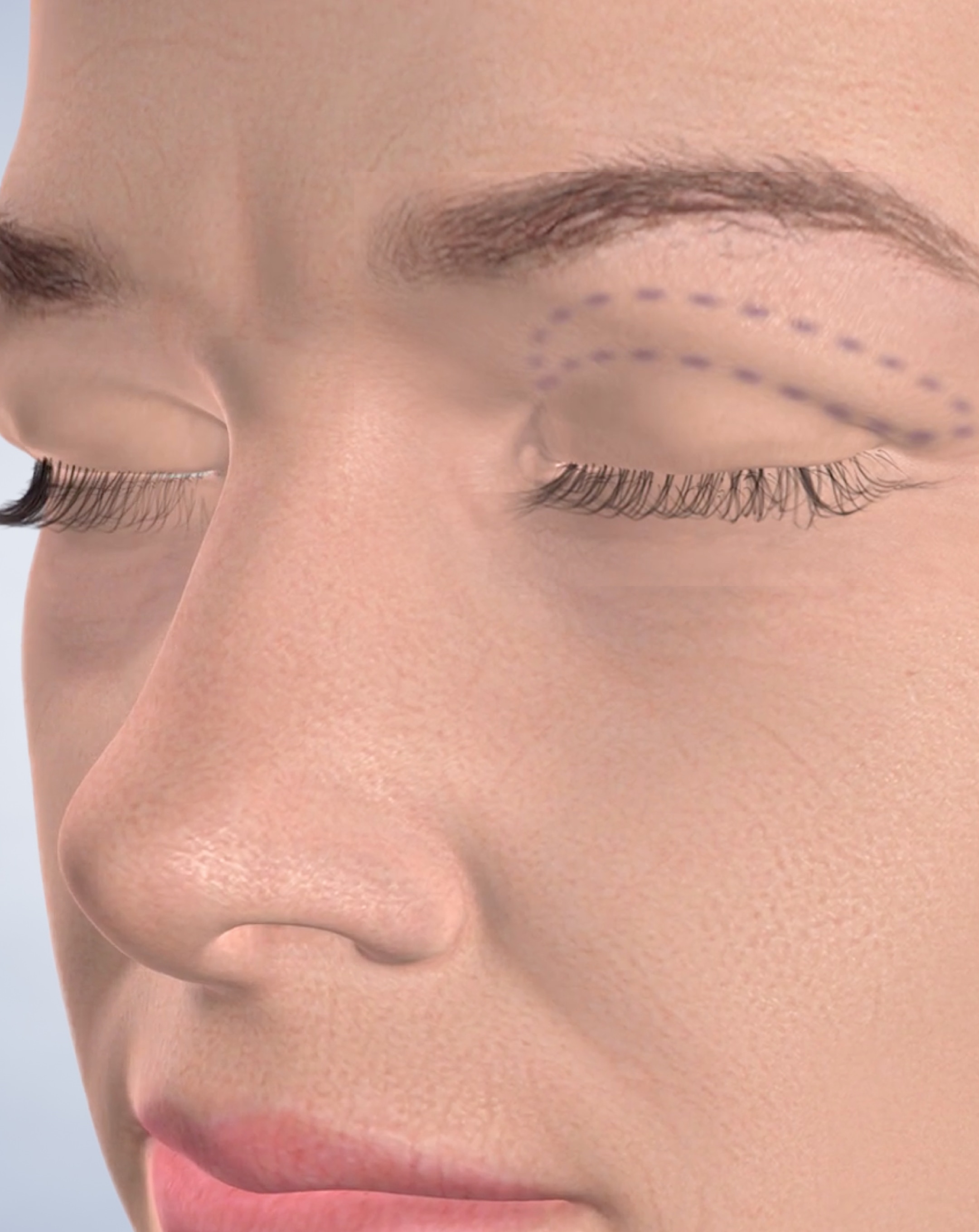 Blepharoplasty in Silverdale, Poulsbo, & Port Orchard, WA Kitsap Oral