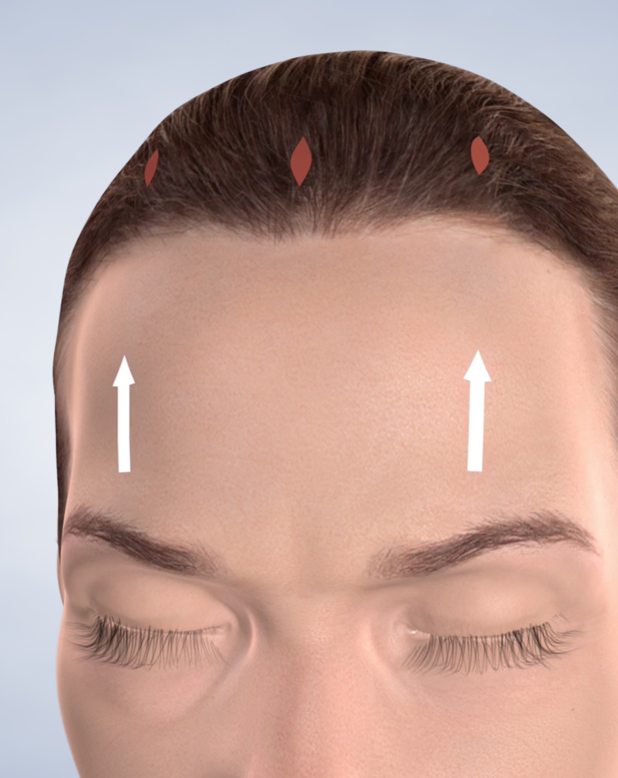 Brow Lift & Forehead Lift in Silverdale, Poulsbo, & Port Orchard, WA