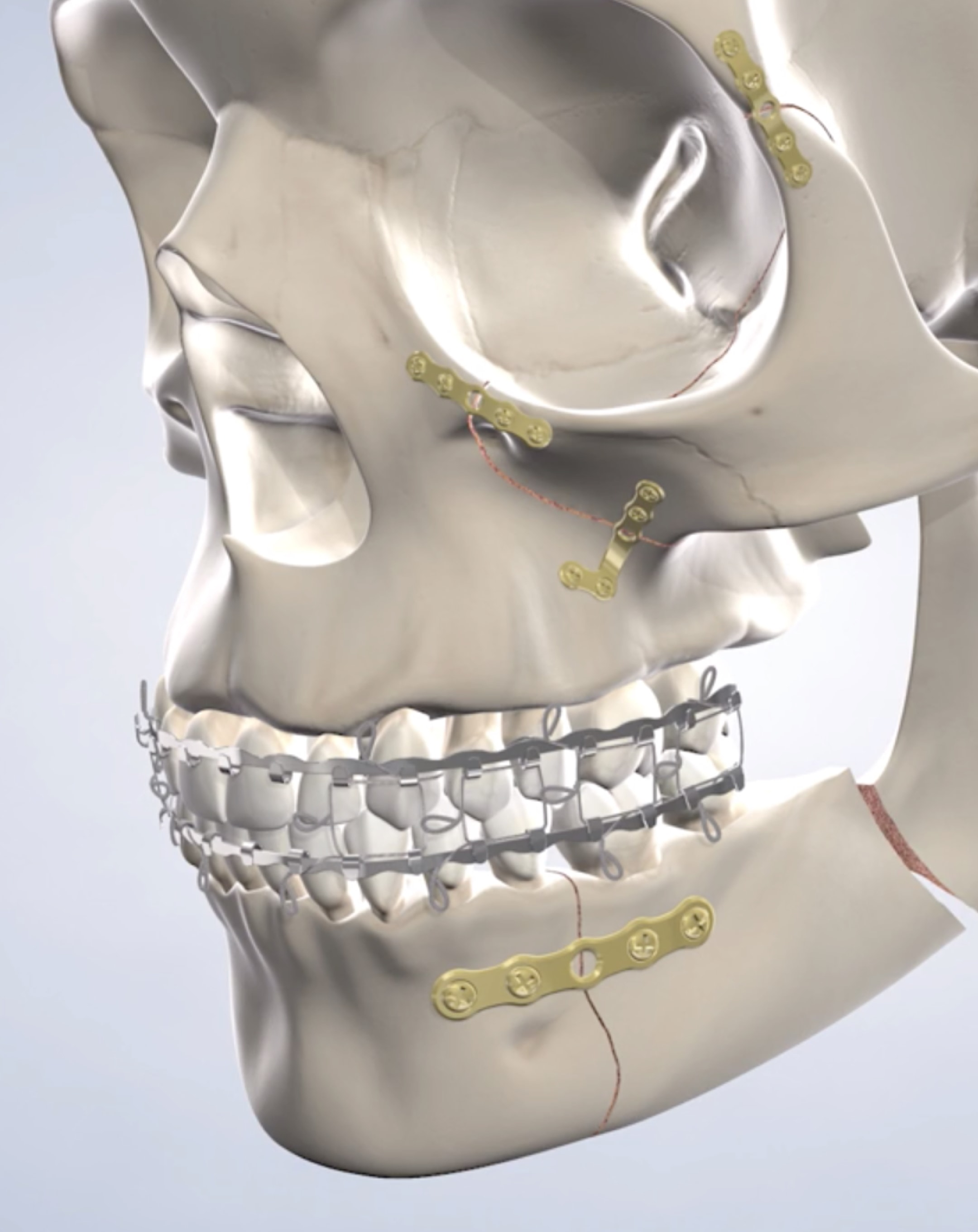 Facial Trauma in Silverdale, Poulsbo, & Port Orchard, WA Kitsap Oral