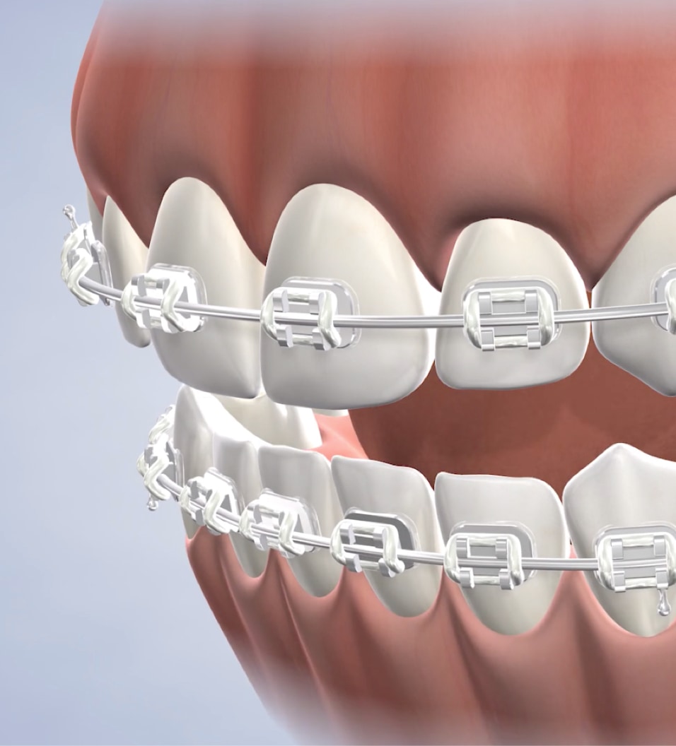 Braces procedure query page